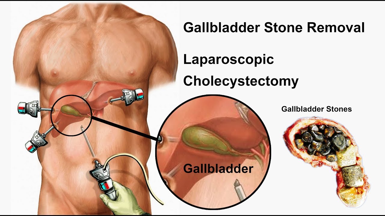 പതത സഞചയല കലല Stone In Gall Blader