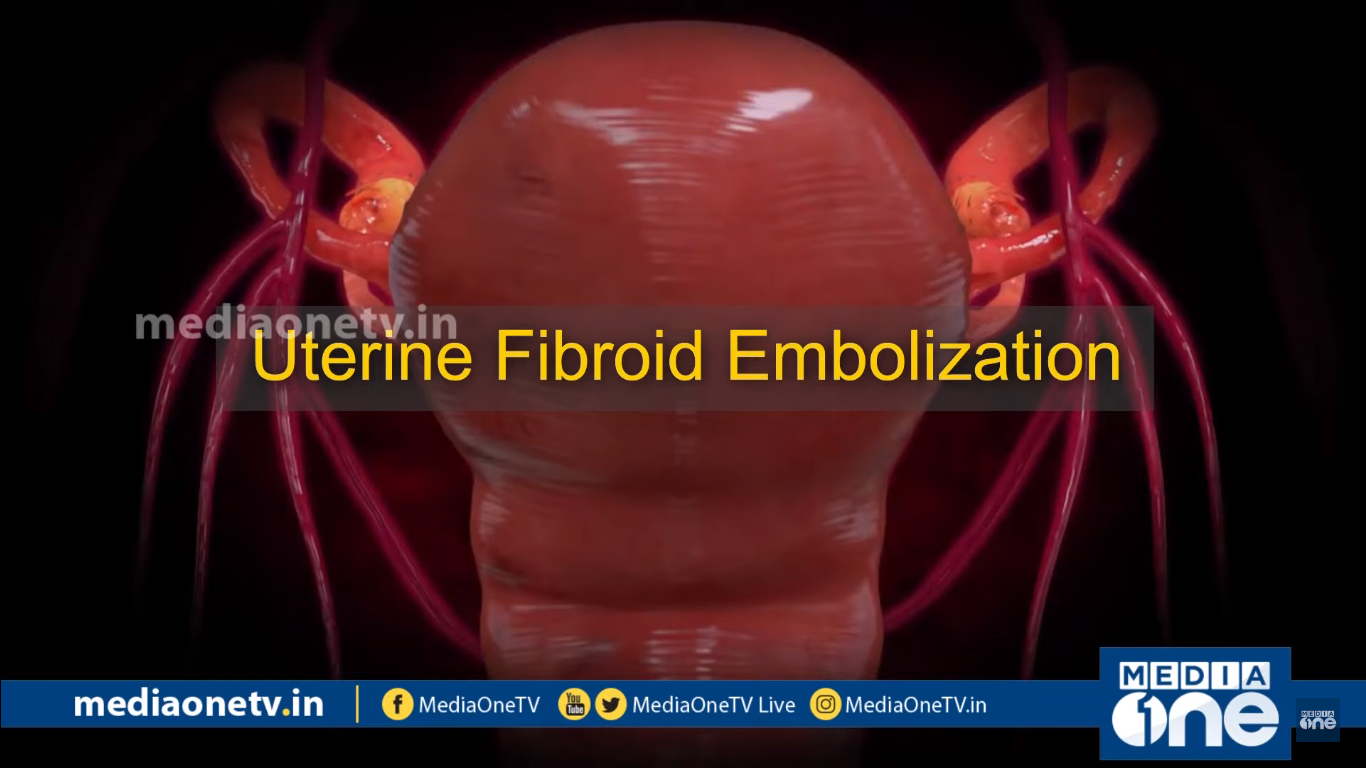 Uterine Fibroid Embolization Stethoscope 